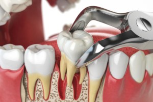 tooth being extracted