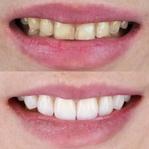 before and after smile makeover in largo