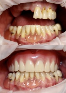 before & after restorative dental patient